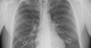 6 Kasus Pneumonia Mycoplasma Ada di dalam area RI, Kemenkes Tidak Tutup Kemungkin Adanya Pandemi Baru
