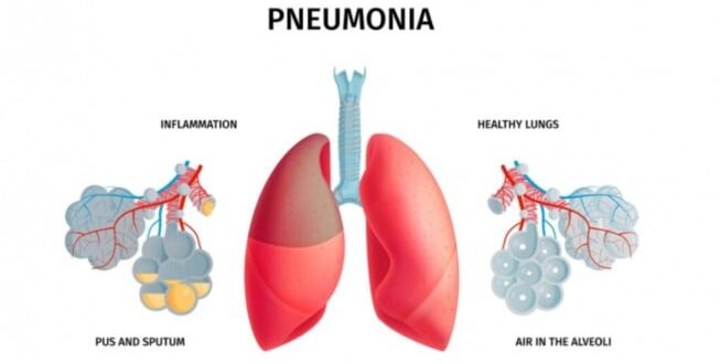 10 Simptom Mycoplasma Pneumoniae, Penyakit Sangat Membahayakan Sudah Masuk Indonesia!